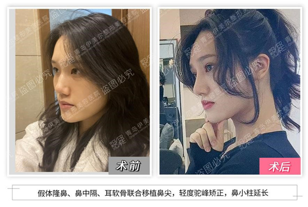 青岛伊美尔岛城美人计第8季，打造精致立体的素颜妈生鼻